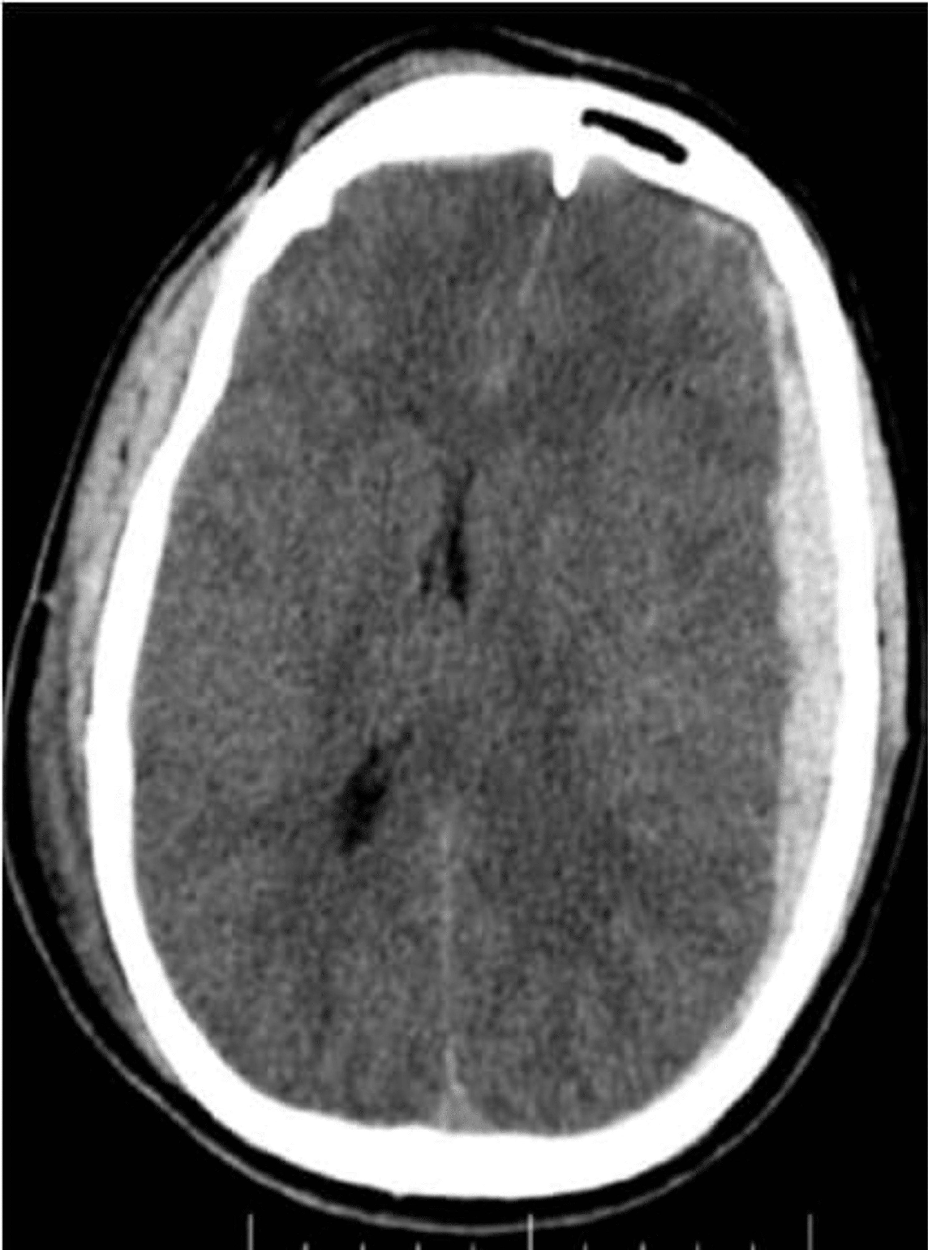 evaluation-of-sequential-head-computed-tomography-in-traumatic-brain-injuries-cureus