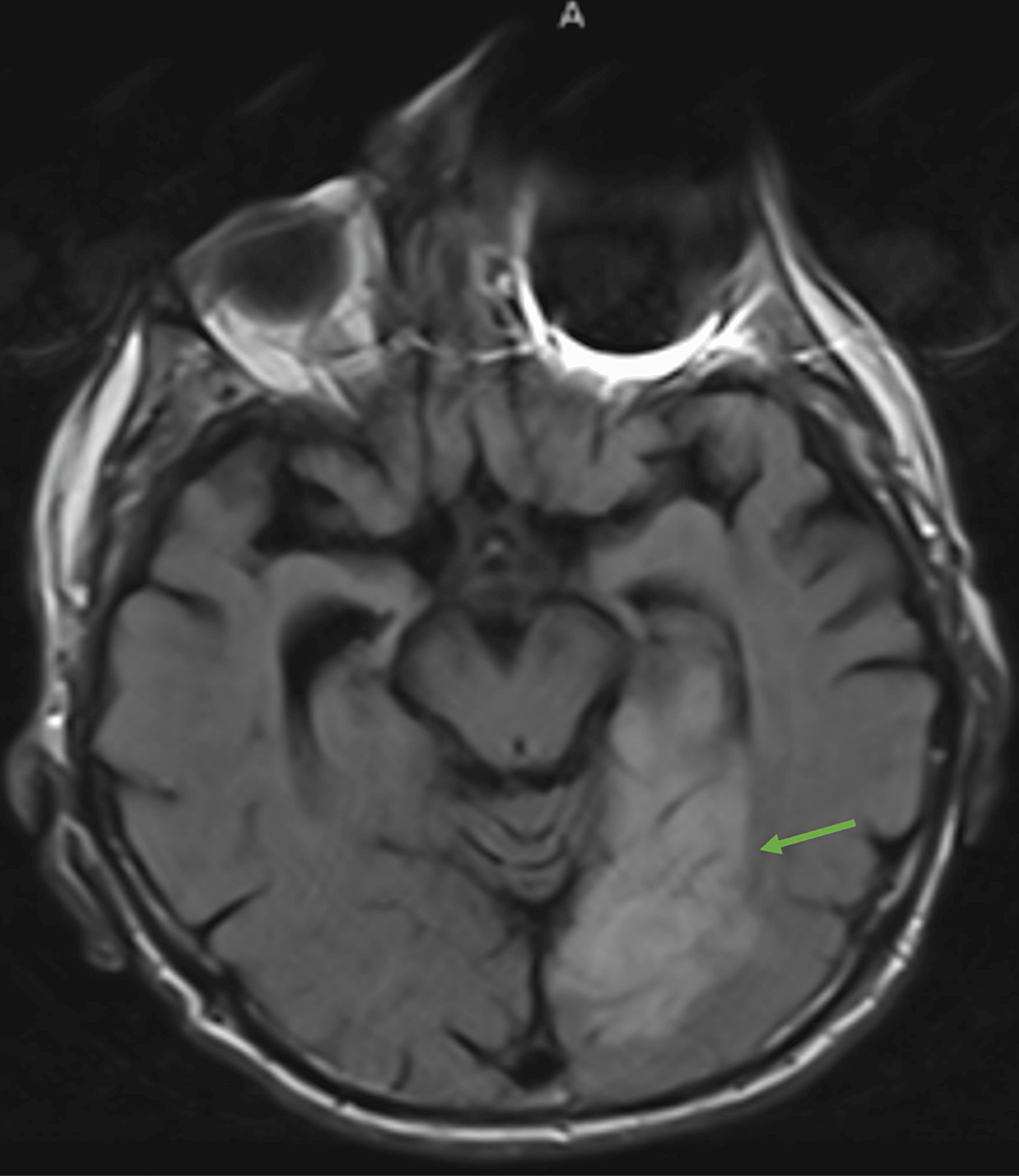 Brain - MRI - Fluid - Attenuated - Reflect - Recovery - (FLAIR) - Scan - (Transverse View) - Show - Acute Stroke - Inside - Zone - From - Left - Back - Brain - Artery - (green arrow)