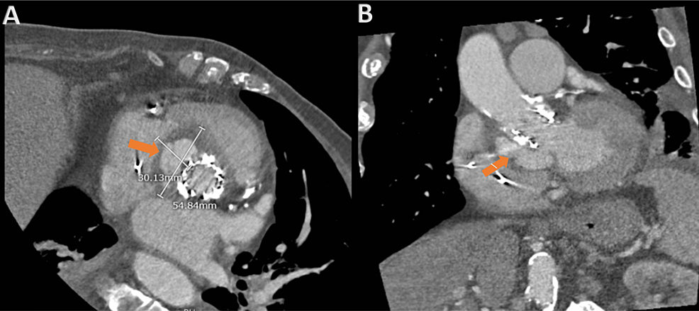 CT images showing, pseudoaneurysm (arrows) on axial (a), and coronal- (b) views