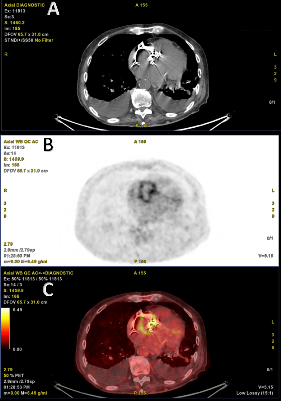 FDG-Positron Emission Tomography (PET)-Scan