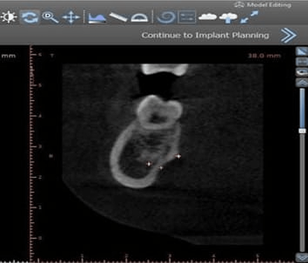 CBCT-with-three-reference-point