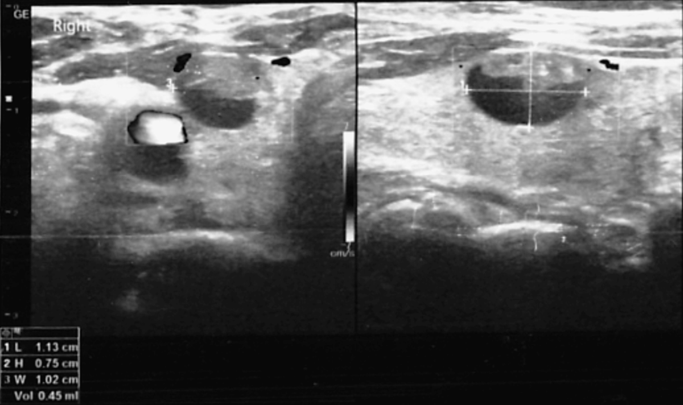 Neck-ultrasound-showing-the-thyroid-nodule-with-cystic-features-and-microcalcifications