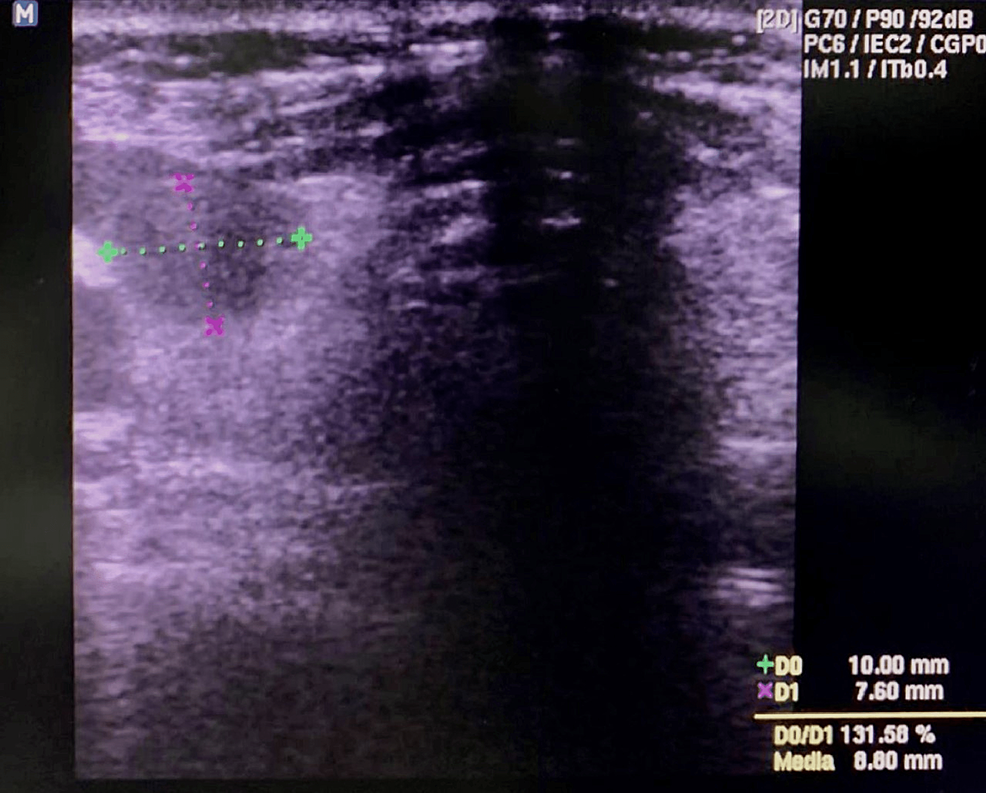 Neck-ultrasound-after-aspiration-of-fluid-from-the-cystic-space