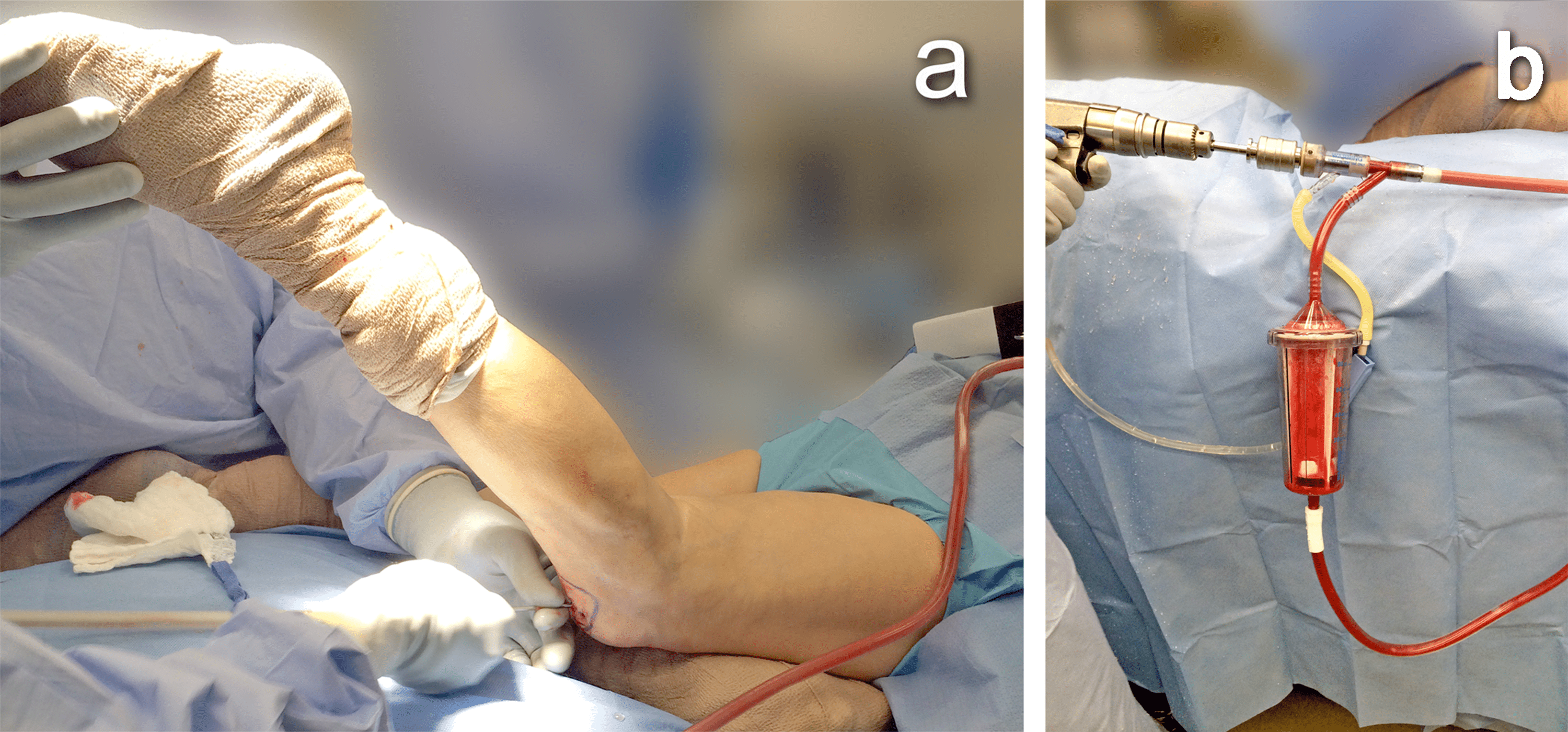 Cureus Fusion Revision Surgery With ReamerIrrigatorAspirator to