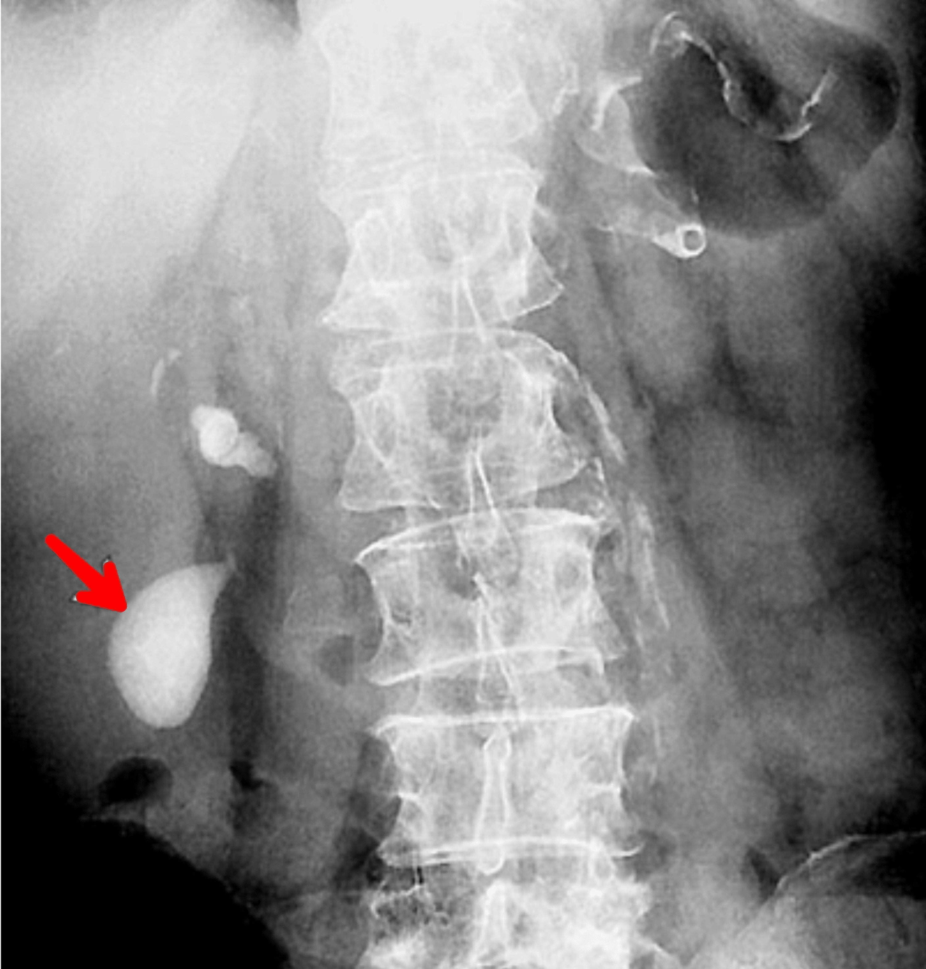 Cureus | Limy Bile Syndrome: A Report of a Rare Case