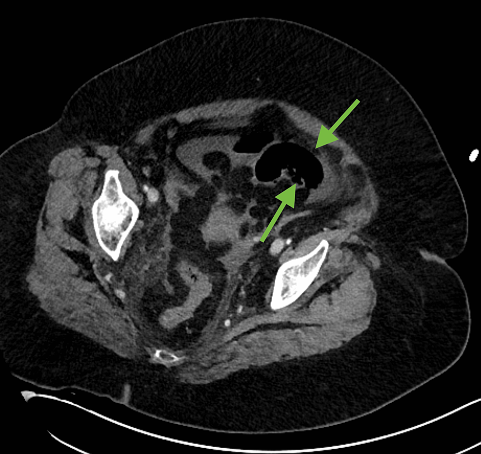 The axial soft tissue window does not allow sufficient visualization to visualize the intestine and pulmonary wall (green arrows).