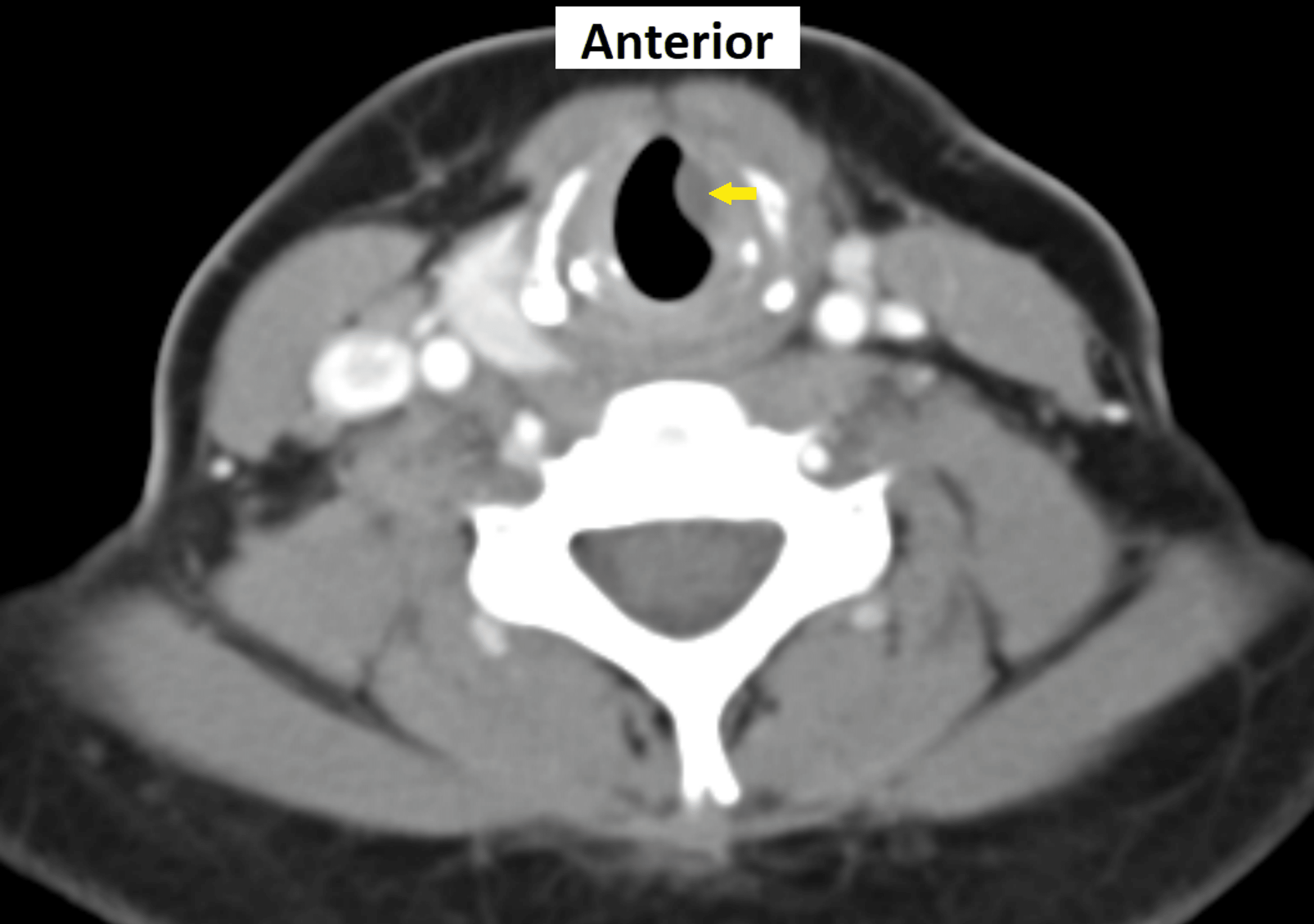 Cureus Subchordal Cyst Containing Nondegraded Hyaluronic Acid A