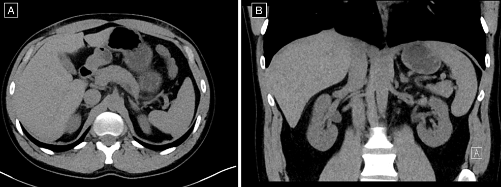 Computed-tomography-adrenals-demonstrating-complete-resolution-of-the-left-adrenal-haematoma-on-(A)-axial-view-and-(B)-coronal-view-at-five-months-follow-up.