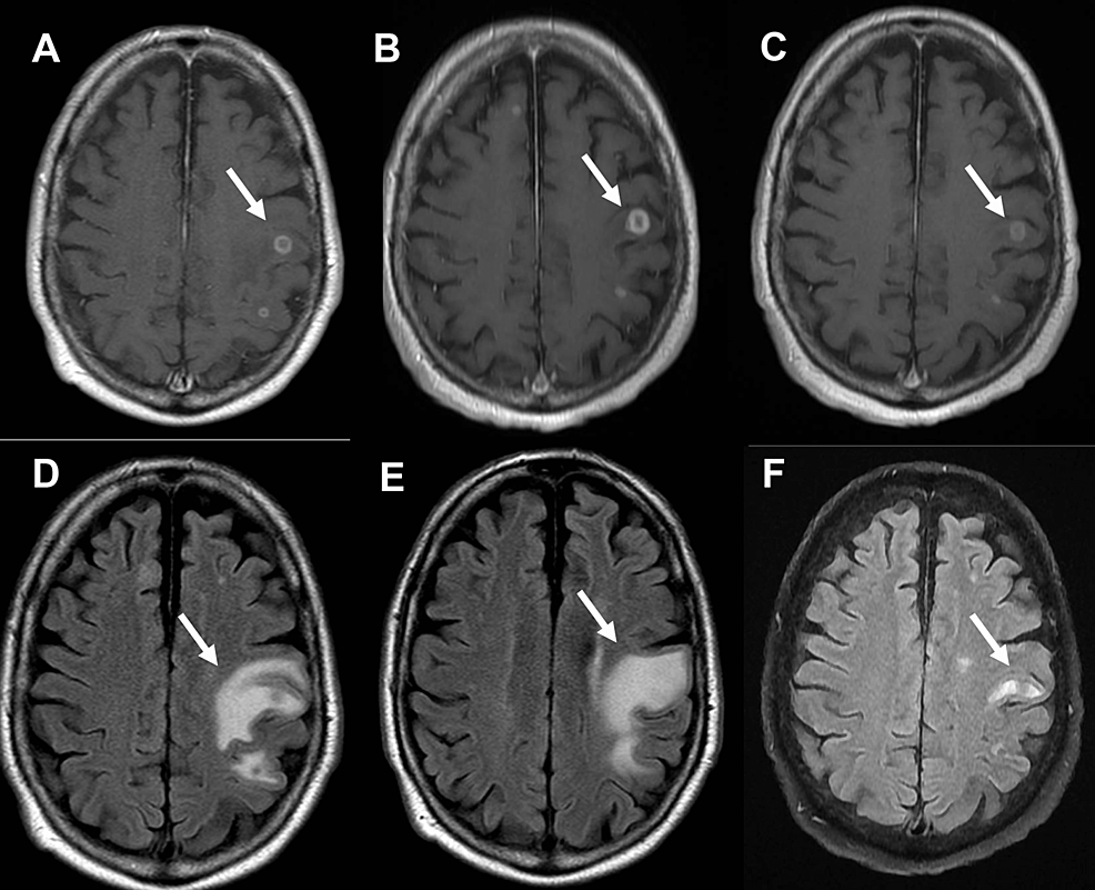 Cureus Reactivation of Disseminated Histoplasmosis With Central
