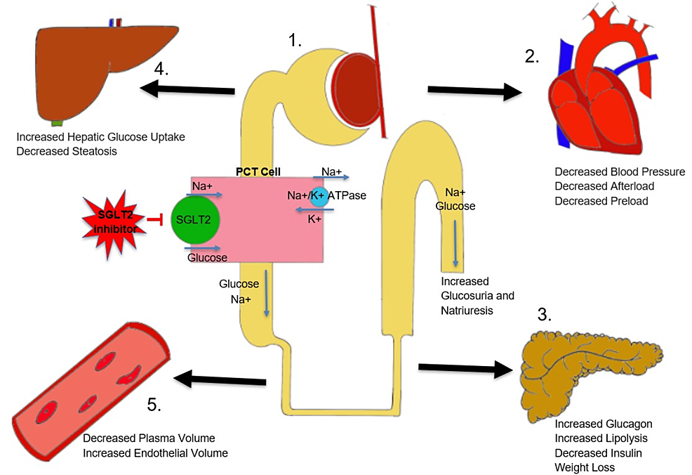 Cureus | Fournier’s Gangrene: A Coexistence or Consanguinity of SGLT-2 ...