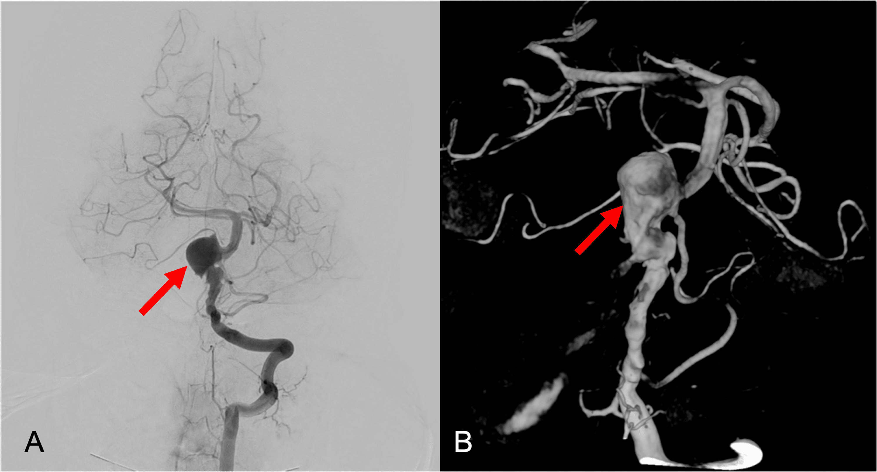 Cureus | Giant Vertebrobasilar Aneurysm: The Rule of Decompressive ...