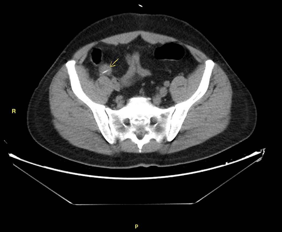 Cureus Unusual Cause of Small Bowel Perforation A Case Report
