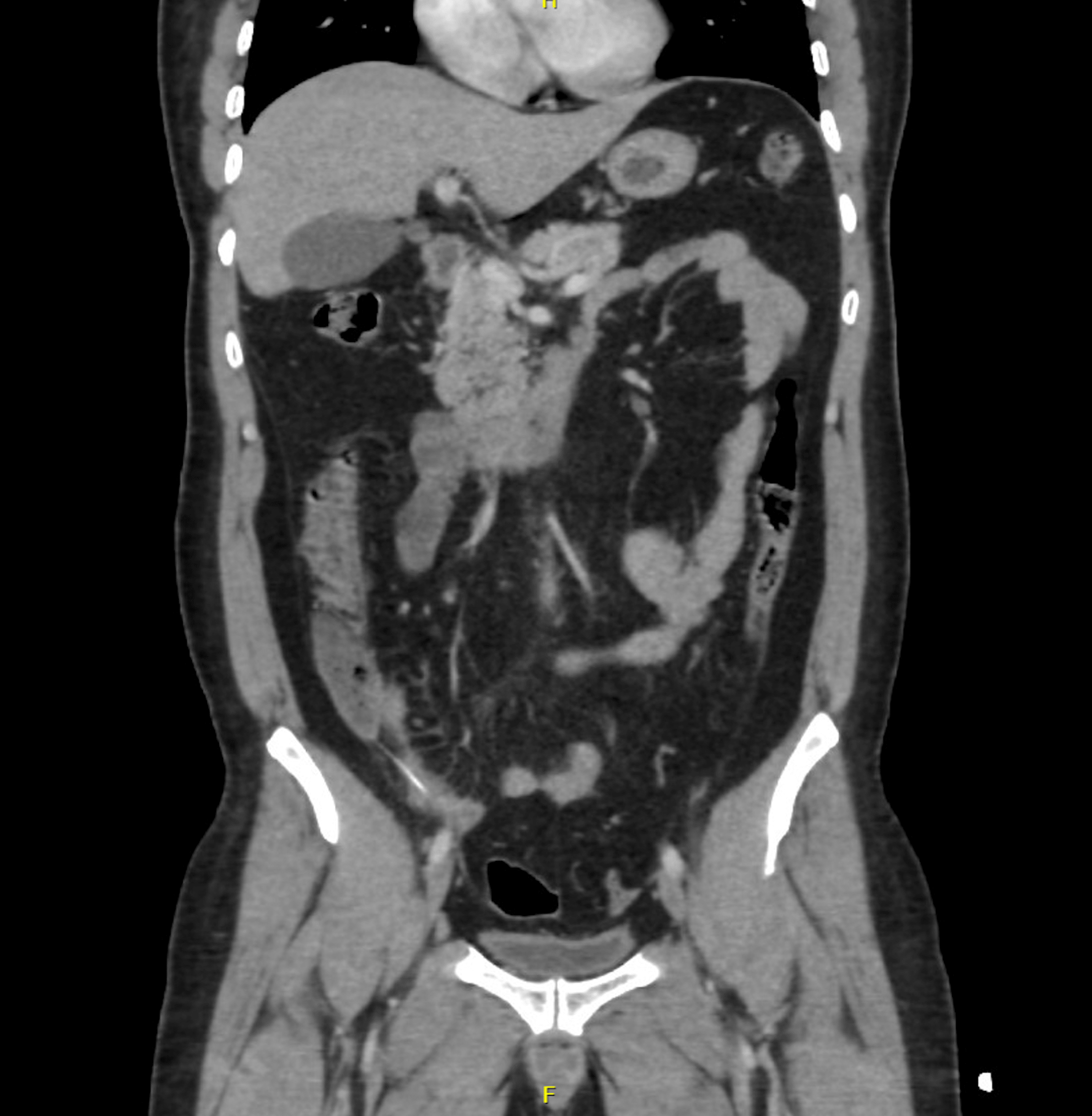 Cureus Unusual Cause of Small Bowel Perforation A Case Report