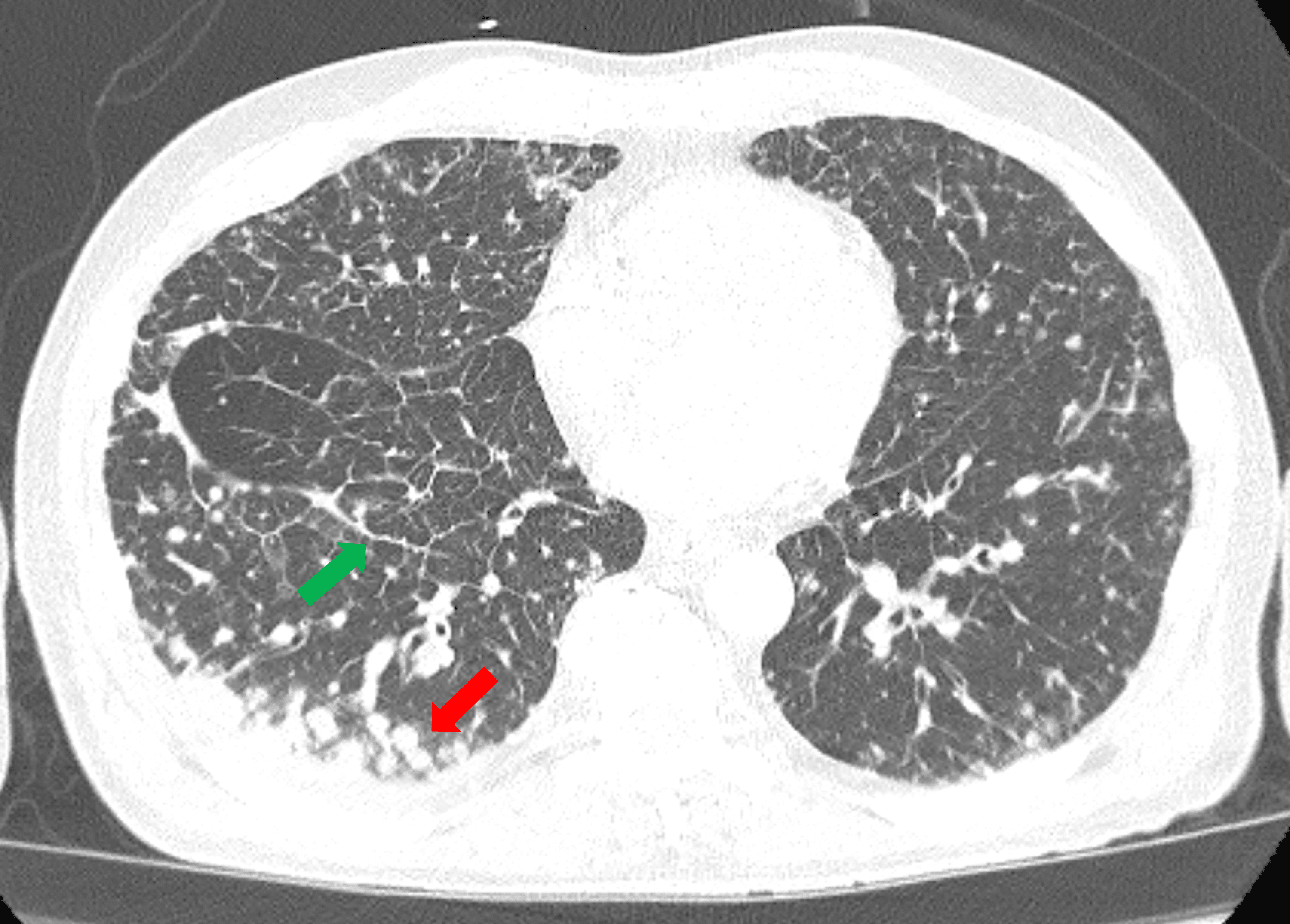 Cureus Pulmonary Lymphangitic Carcinomatosis An Atypical Presentation Leading To Discovery Of 