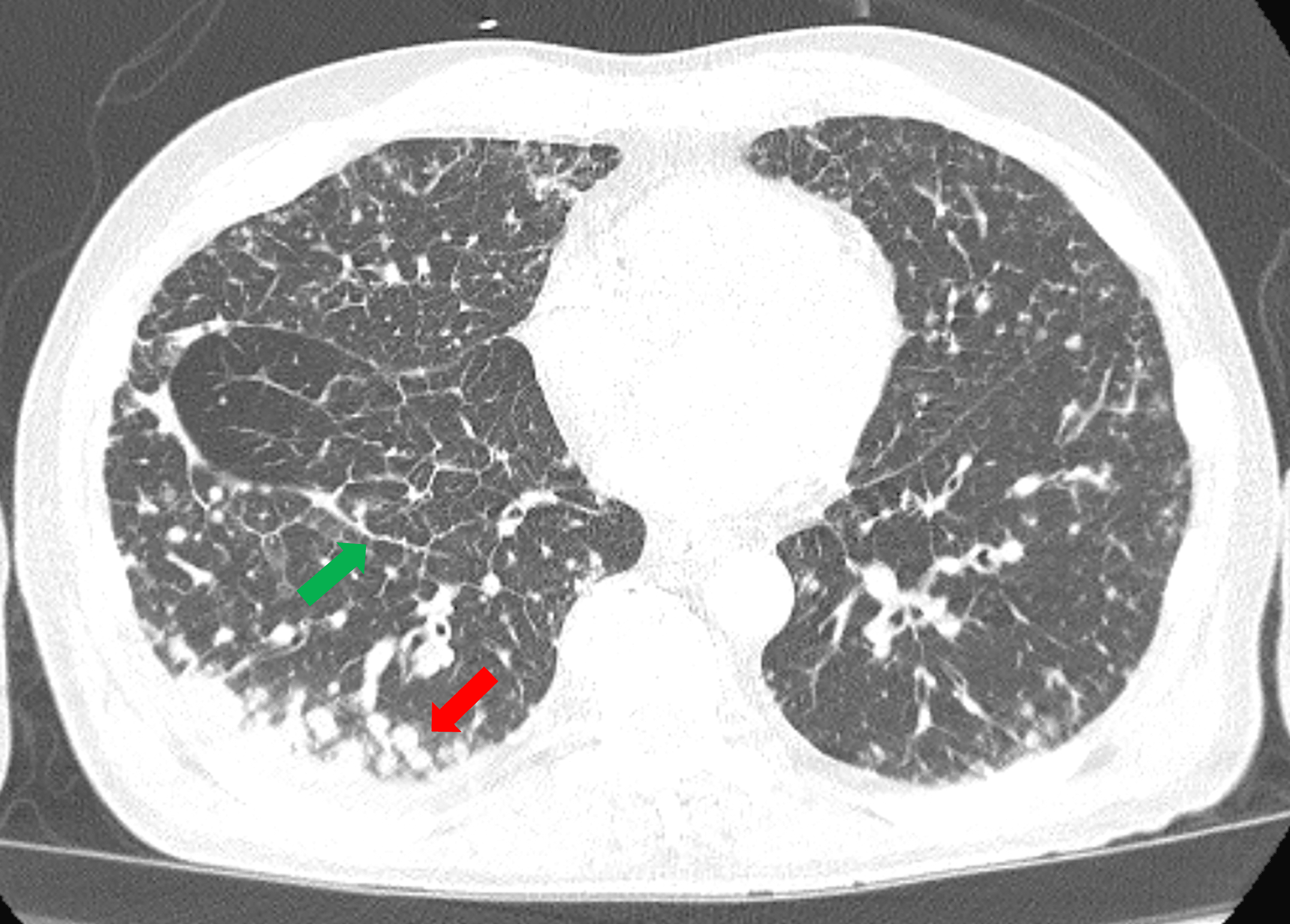 peritoneal-carcinose-ascites-sono-text-doccheck