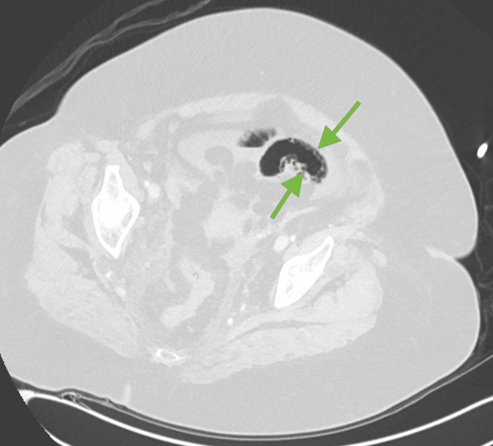 Axial-lung-window-allows-for-visualization-of-bowel-wall-pneumatosis-(green-arrows).