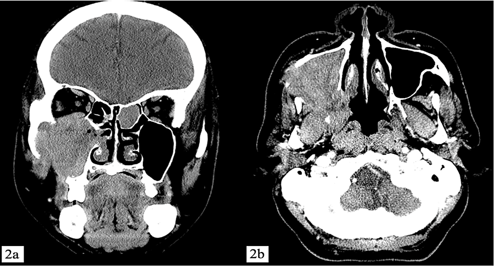 Contrast-enhanced-computed-tomography-(CECT)-of-paranasal-sinuses-coronal-(a)-and-axial-(b)-views