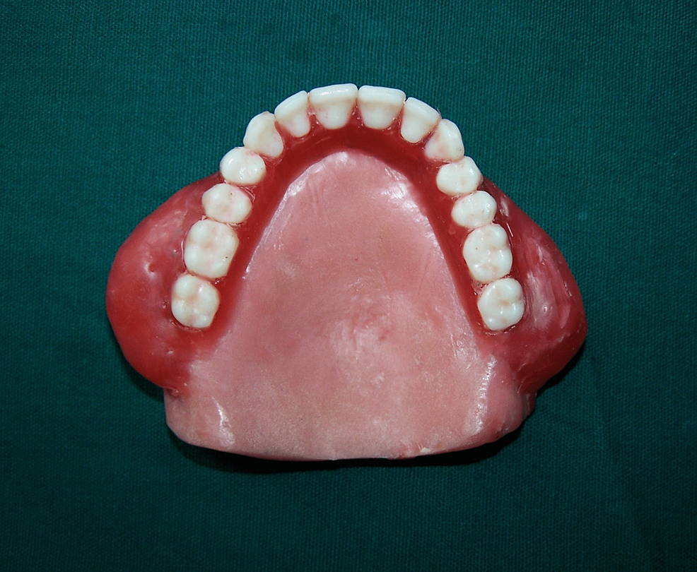 enhancing-facial-esthetics-in-a-complete-denture-patient-having-sunken