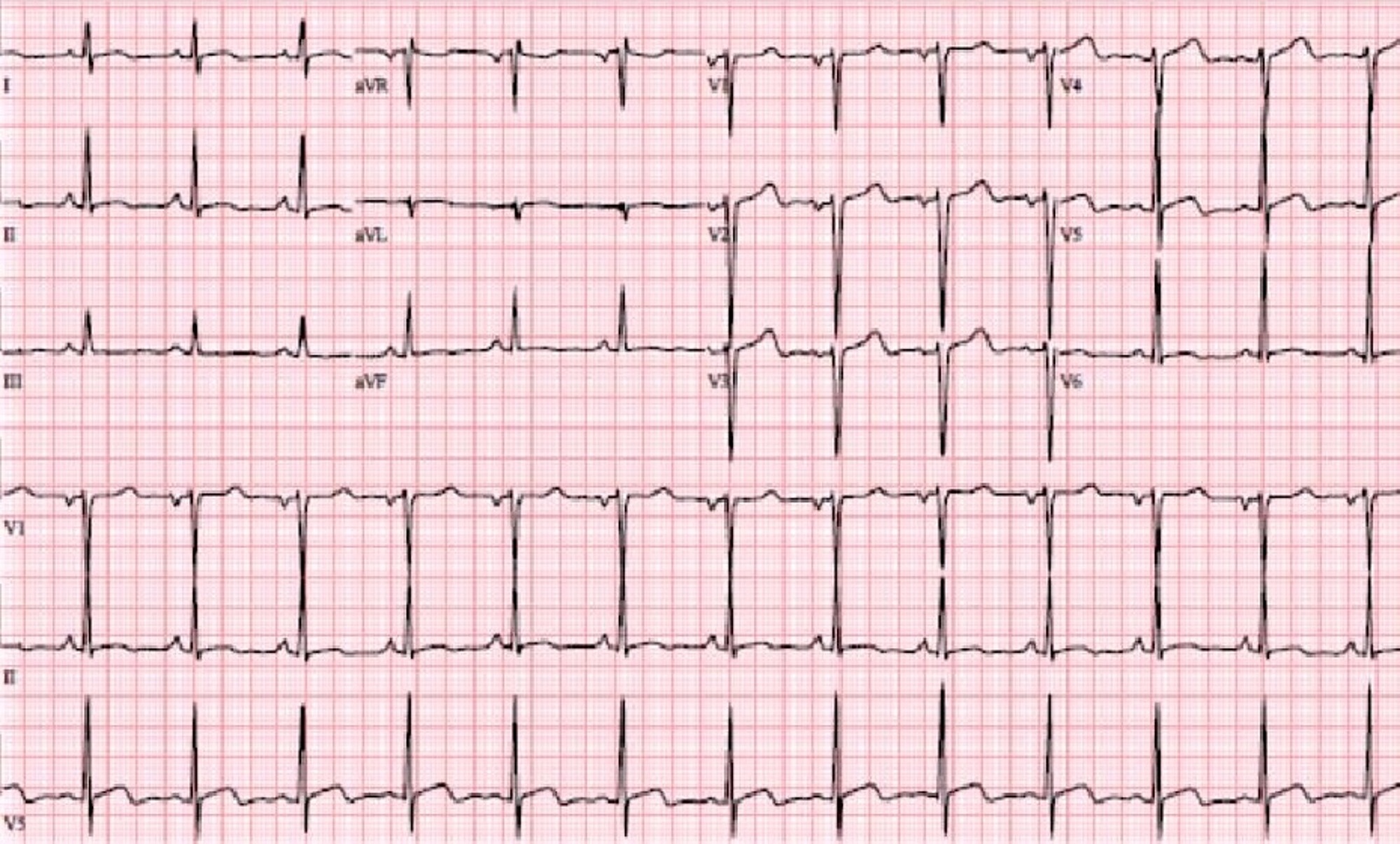 Cureus | Reversible Left Ventricular Systolic Dysfunction Secondary to ...