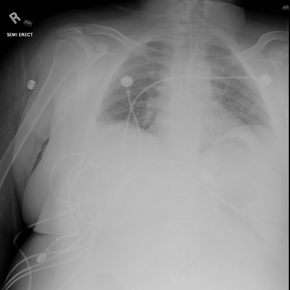 Cureus A Rare Case of Hashimoto’s Encephalopathy With Mosaic Turner