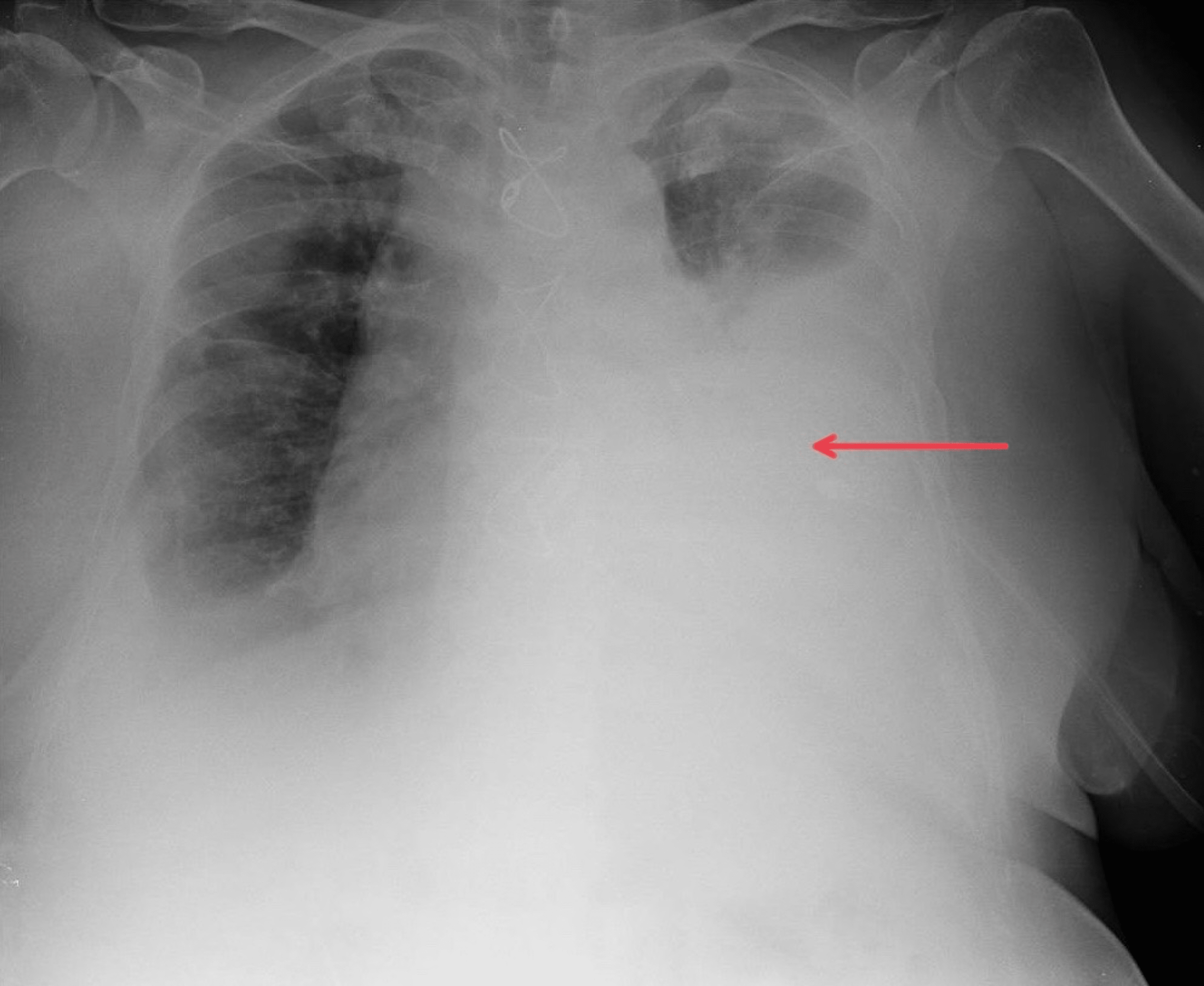 Cureus | Intrapleural Fibrinolytic Therapy With Alteplase for the ...