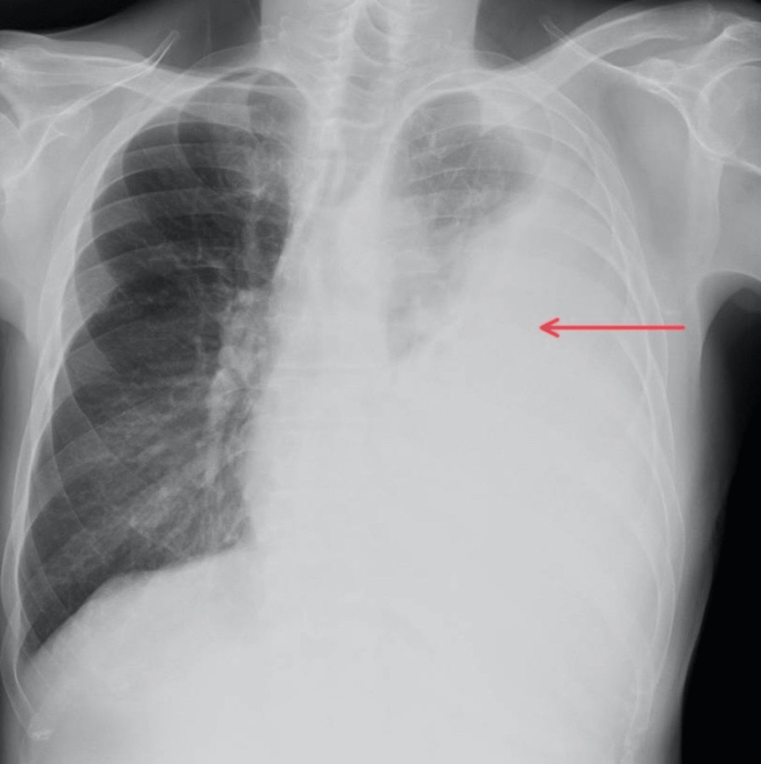 Cureus | Intrapleural Fibrinolytic Therapy With Alteplase for the ...