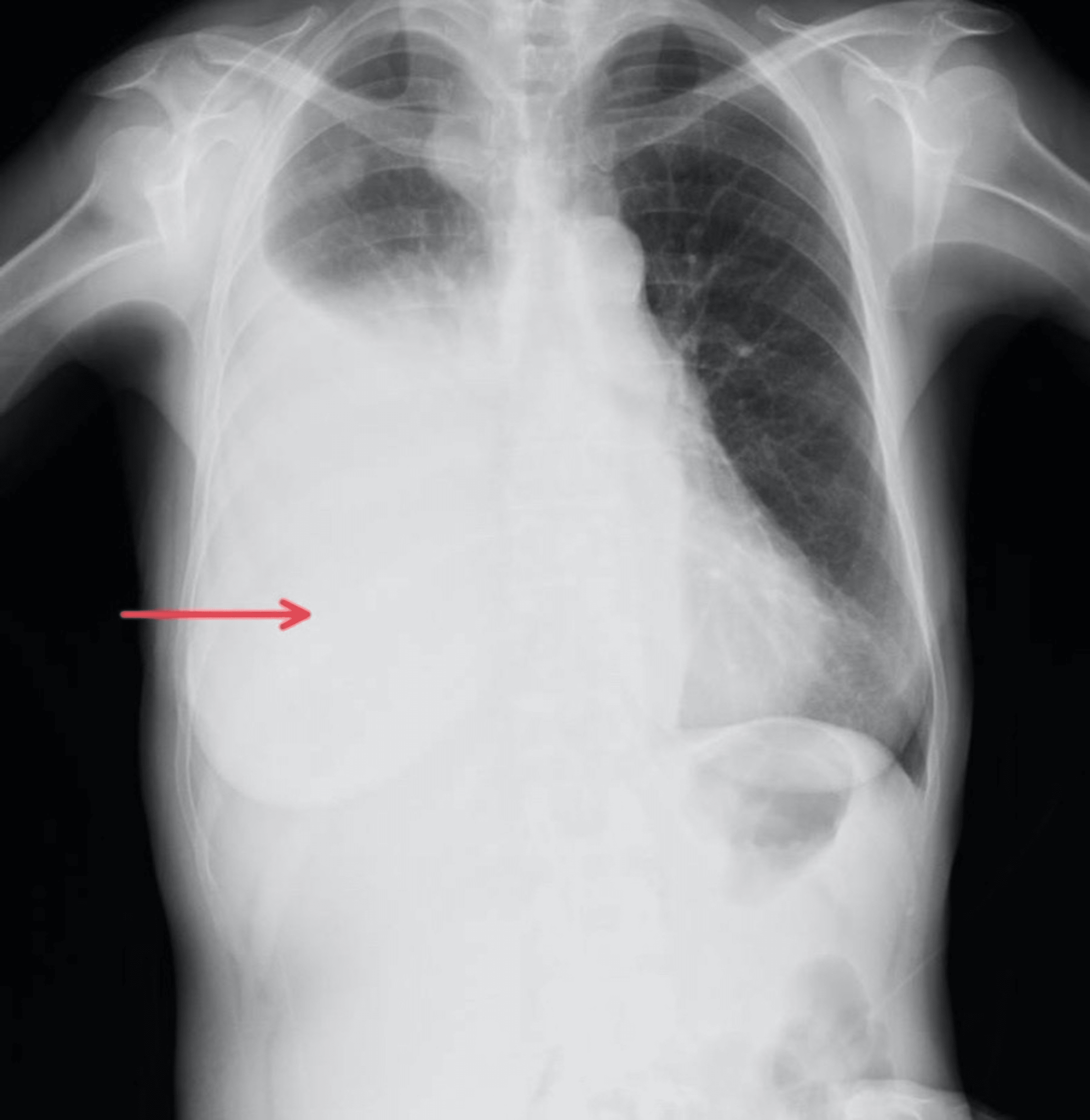 Cureus Intrapleural Fibrinolytic Therapy With Alteplase For The Management Of Multiloculated