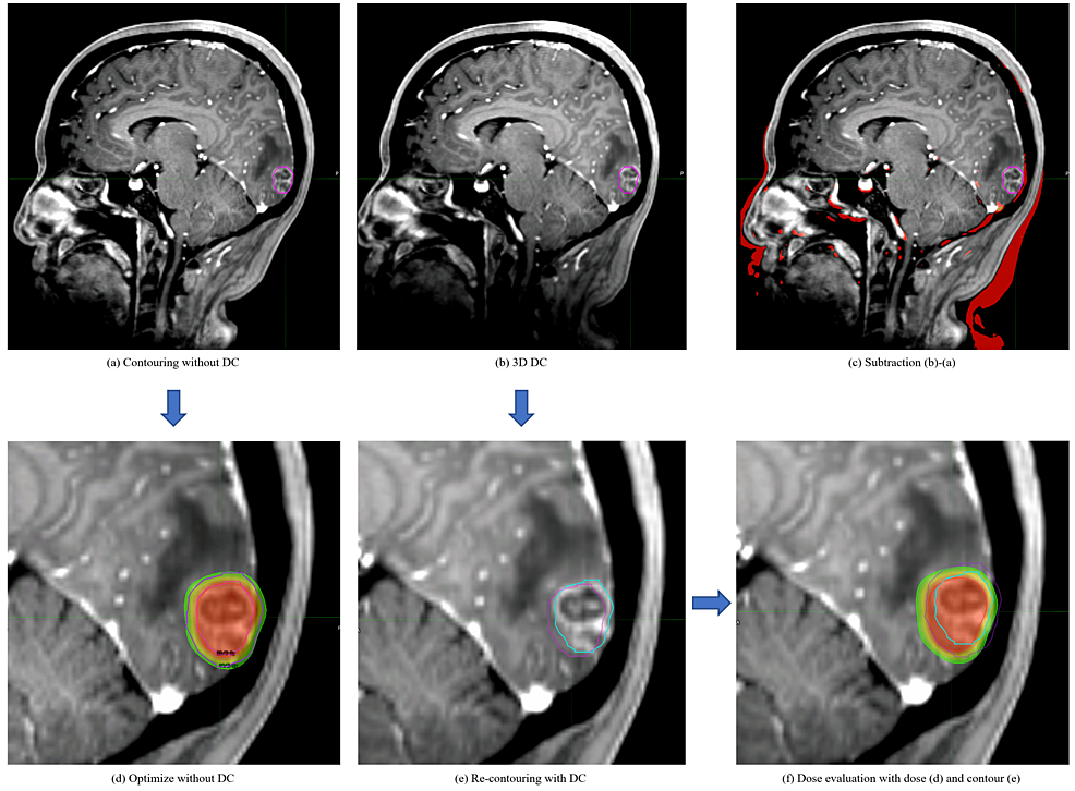 Dose-distribution-comparison-between-tumor-delineation-with-and-without-distortion-correction-(DC)