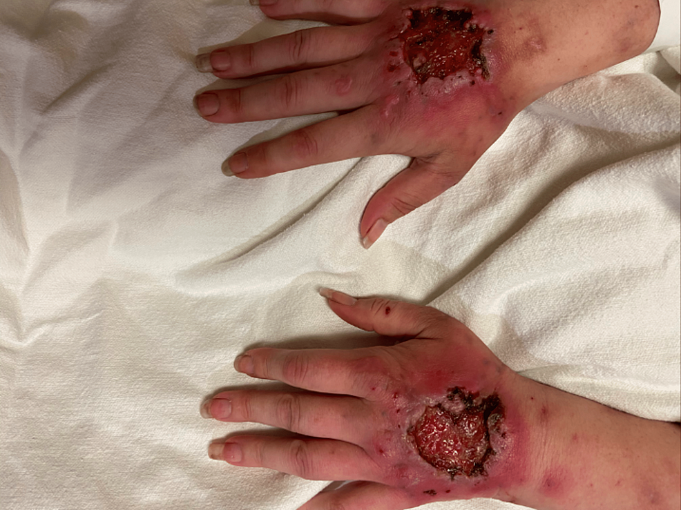 Heroin-induced-skin-necrosis-of-the-bilateral-dorsal-hands-with-erythematous-ulcerations
