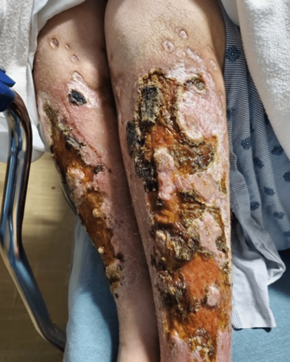 Heroin-induced-skin-necrosis-on-ventral-bilateral-lower-extremities-with-coalescing-necrotic-ulcers-and-necrotic-scaling