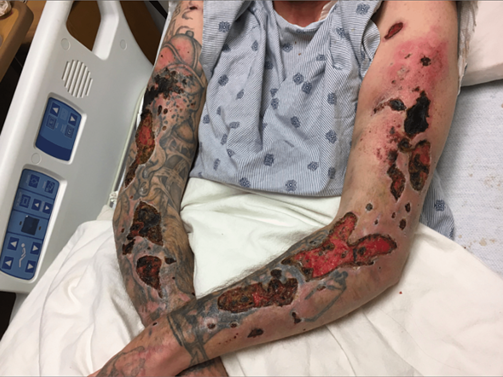 Heroin-induced-skin-necrosis-on-the-dorsal-bilateral-upper-extremities-with-scattered-necrotic-ulcers-and-necrotic-scaling