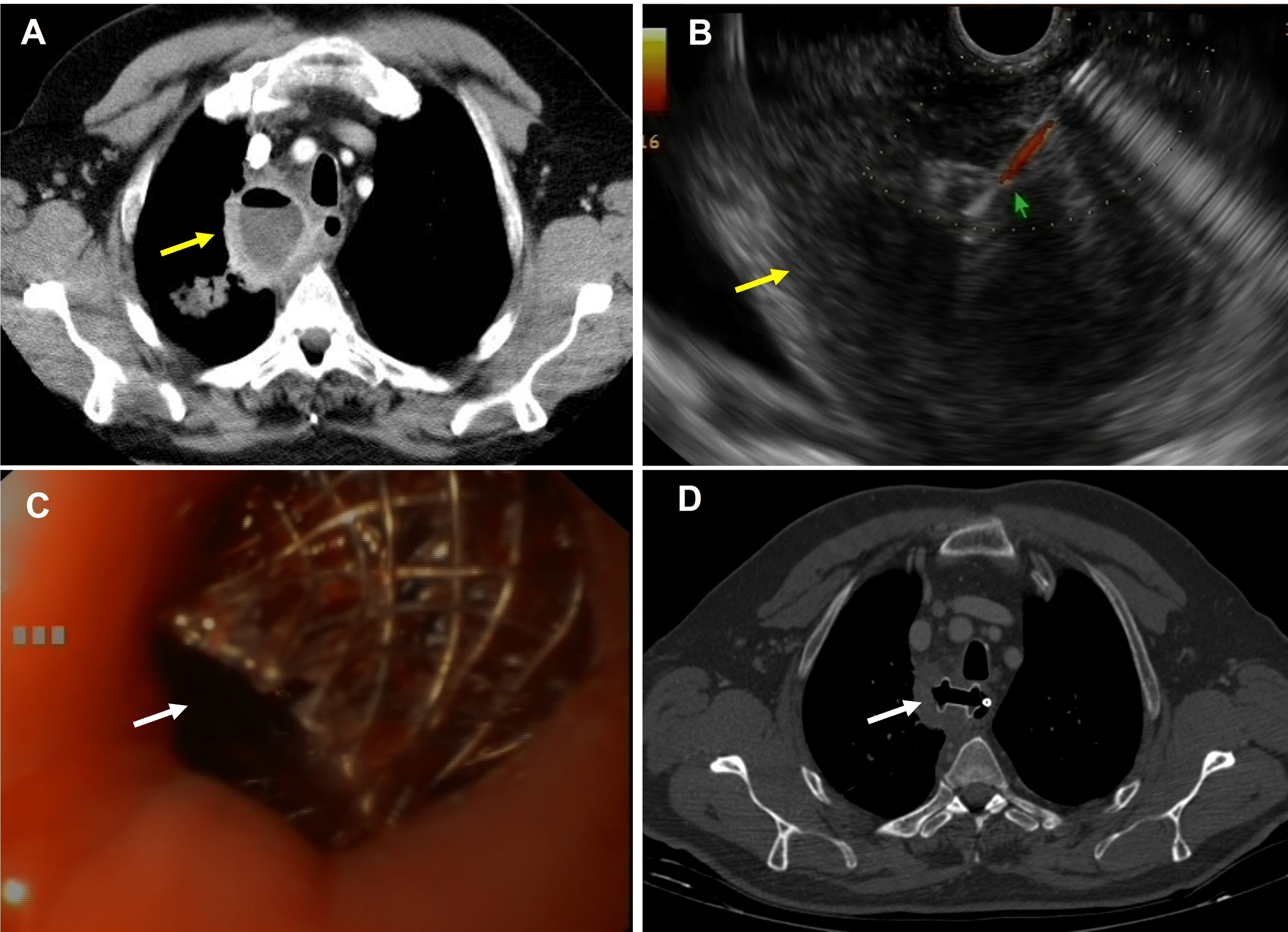 Cureus The Role Of Endoscopic Ultrasound In The Interventional Management Of Mediastinal