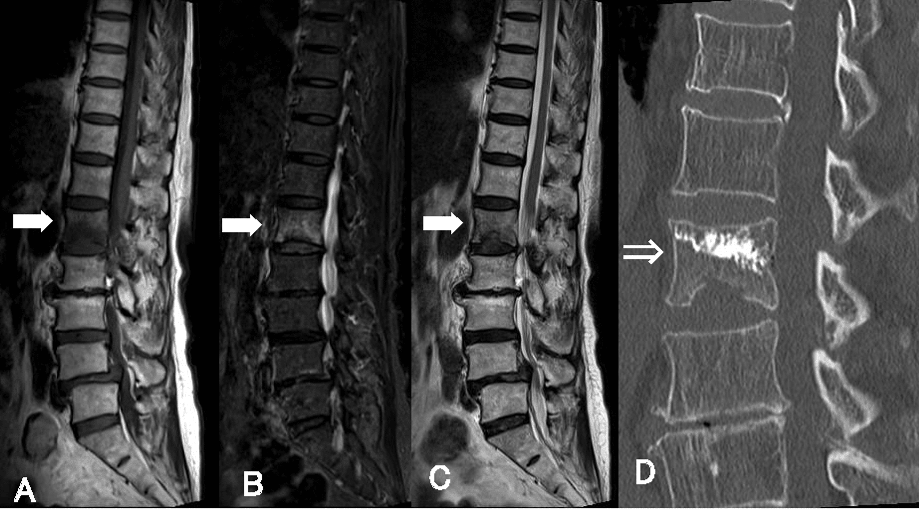 Cureus | Vertebral Fracture in an Elderly Golfer