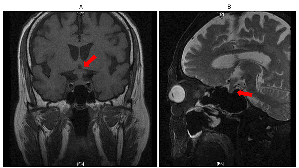 Imagen de resonancia magnética del cerebro el 2 de junio.