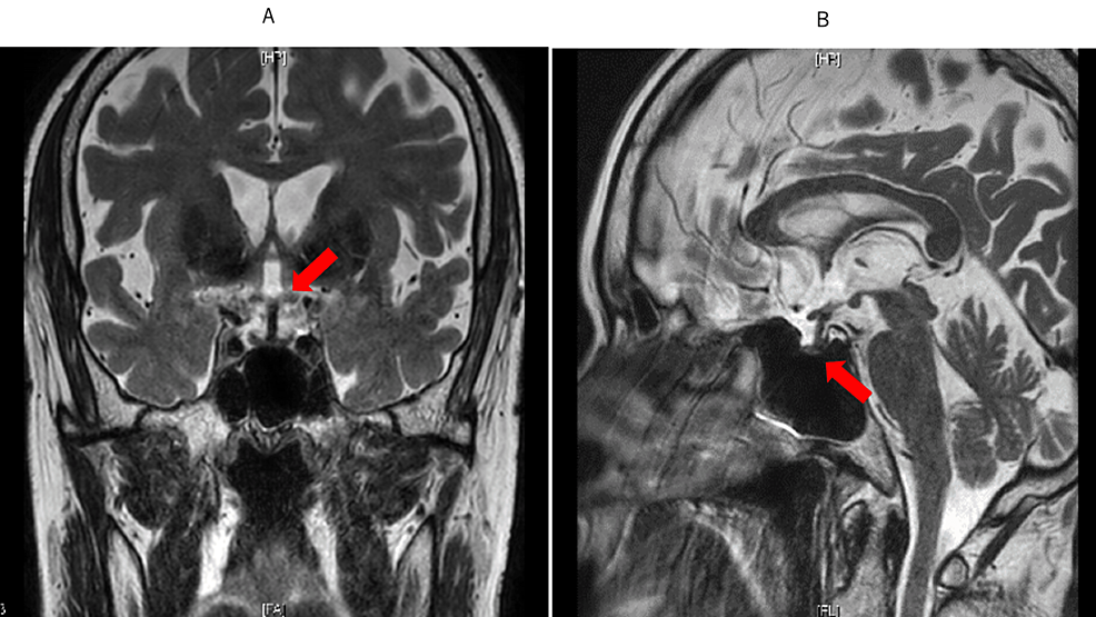 Imagen de resonancia magnética del cerebro el 2 de junio.