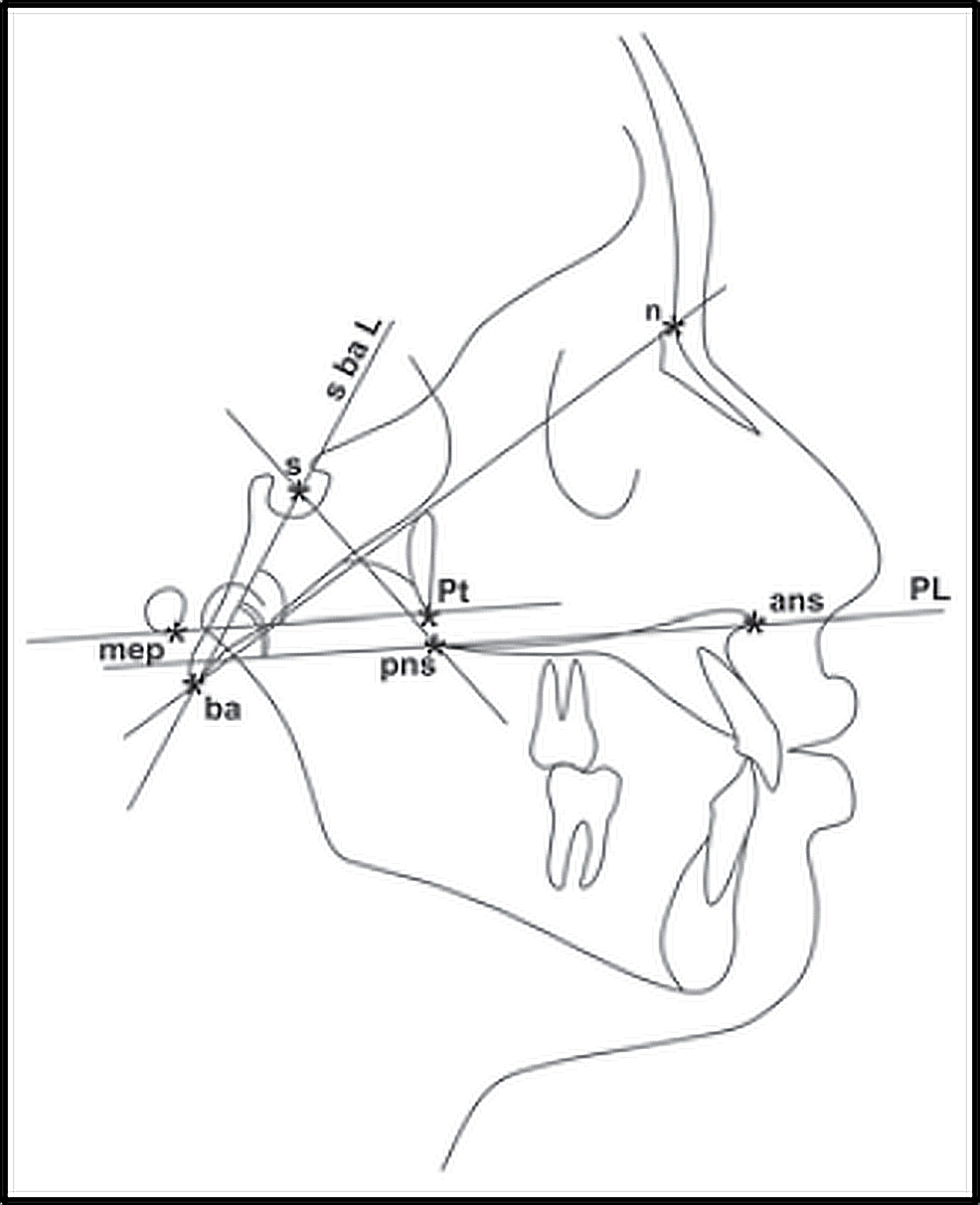 Comparative Assessment of Cephalometric and Tympanometric Readings in ...