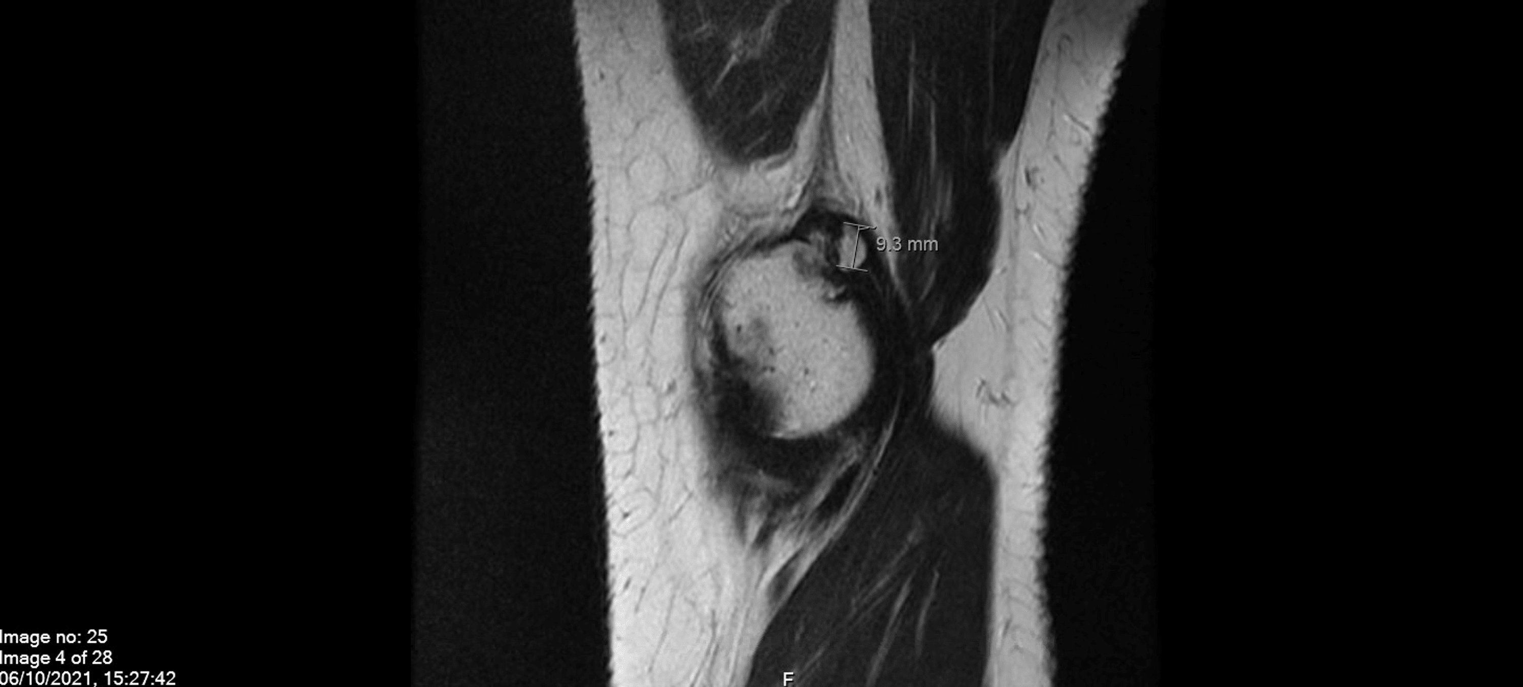 Cureus A Case Report of Reactive Arthritis After COVID19 AstraZeneca