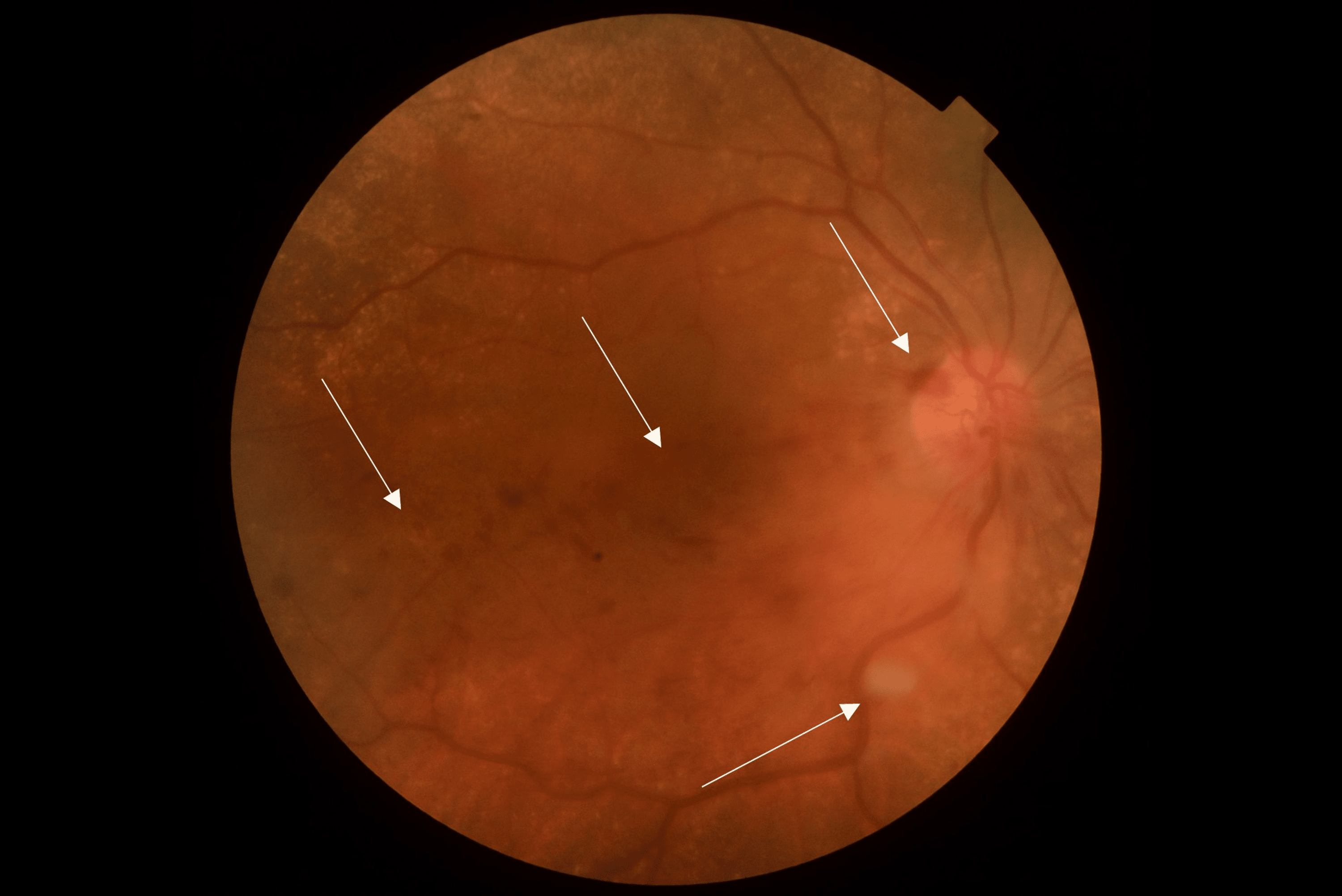 Cureus Retinal Vein Occlusion In A Patient On Dabrafenib And