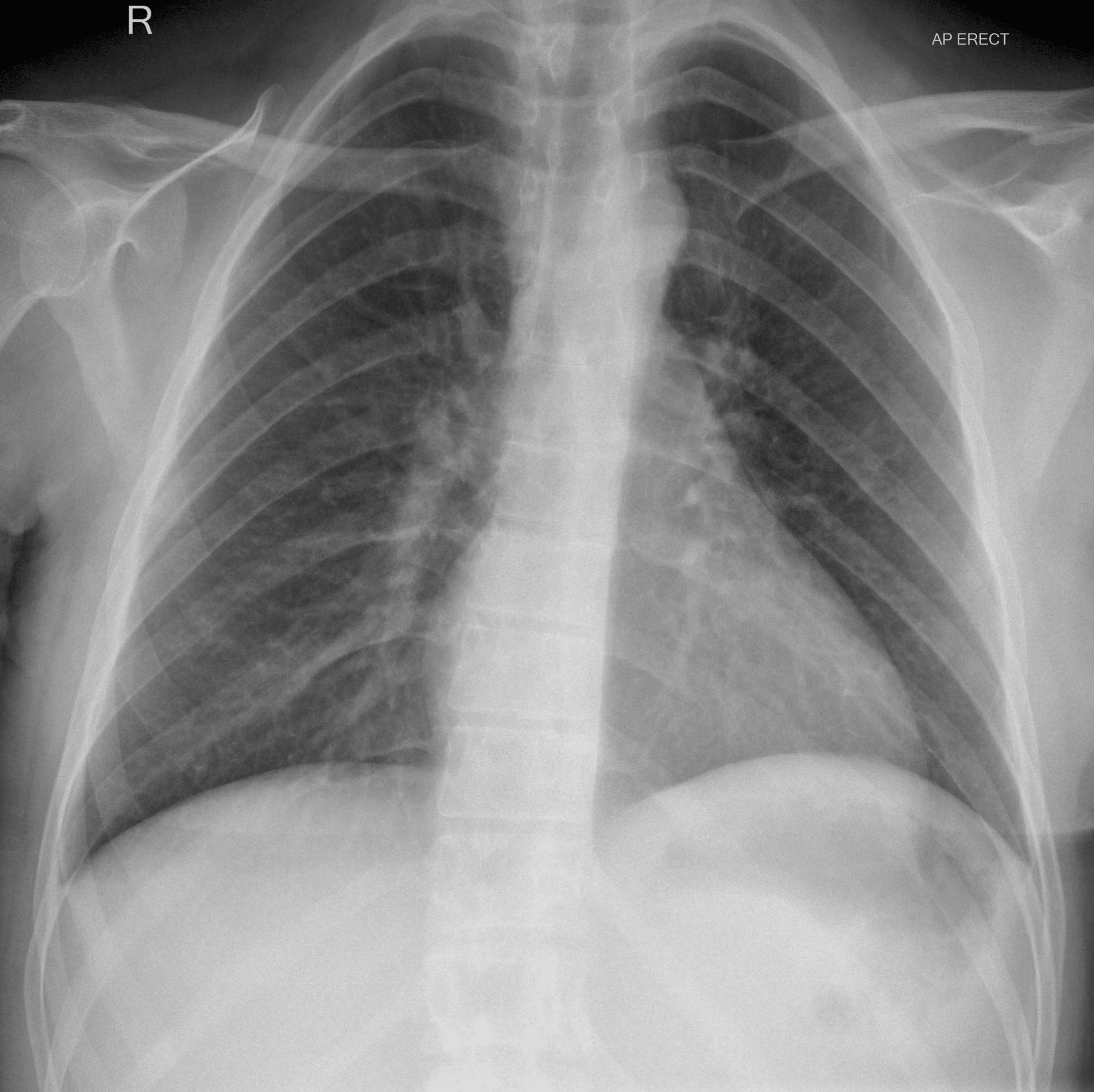 Cureus Neurogenic Pulmonary Edema Presenting As A Pulmonary Entity