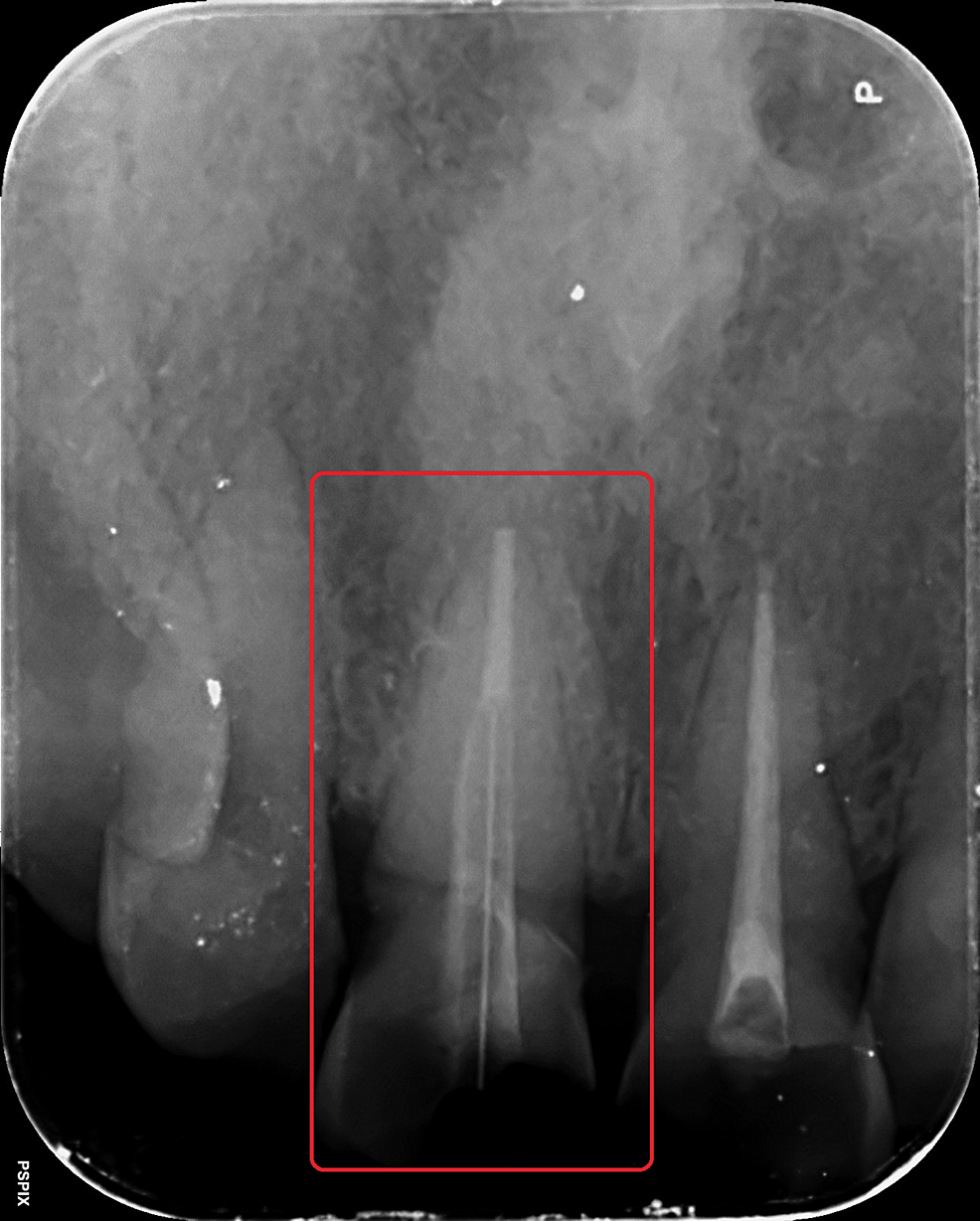 Post-cementation-with-respect-to-tooth-11