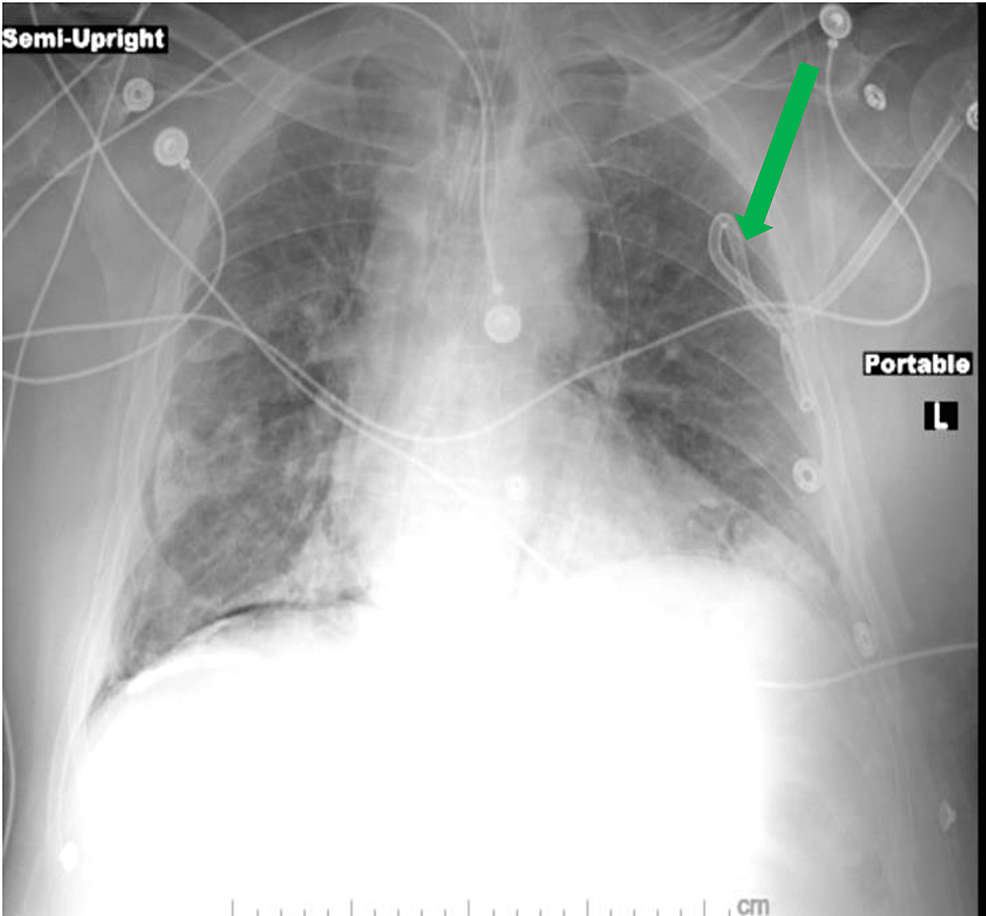 Chest-radiograph,-with-left-sided-chest-tube-in-place-and-improvement-of-pneumothorax.-Green-arrow-chest-tube.-A-persistent-right-pneumothorax-that-did-not-require-decompression.