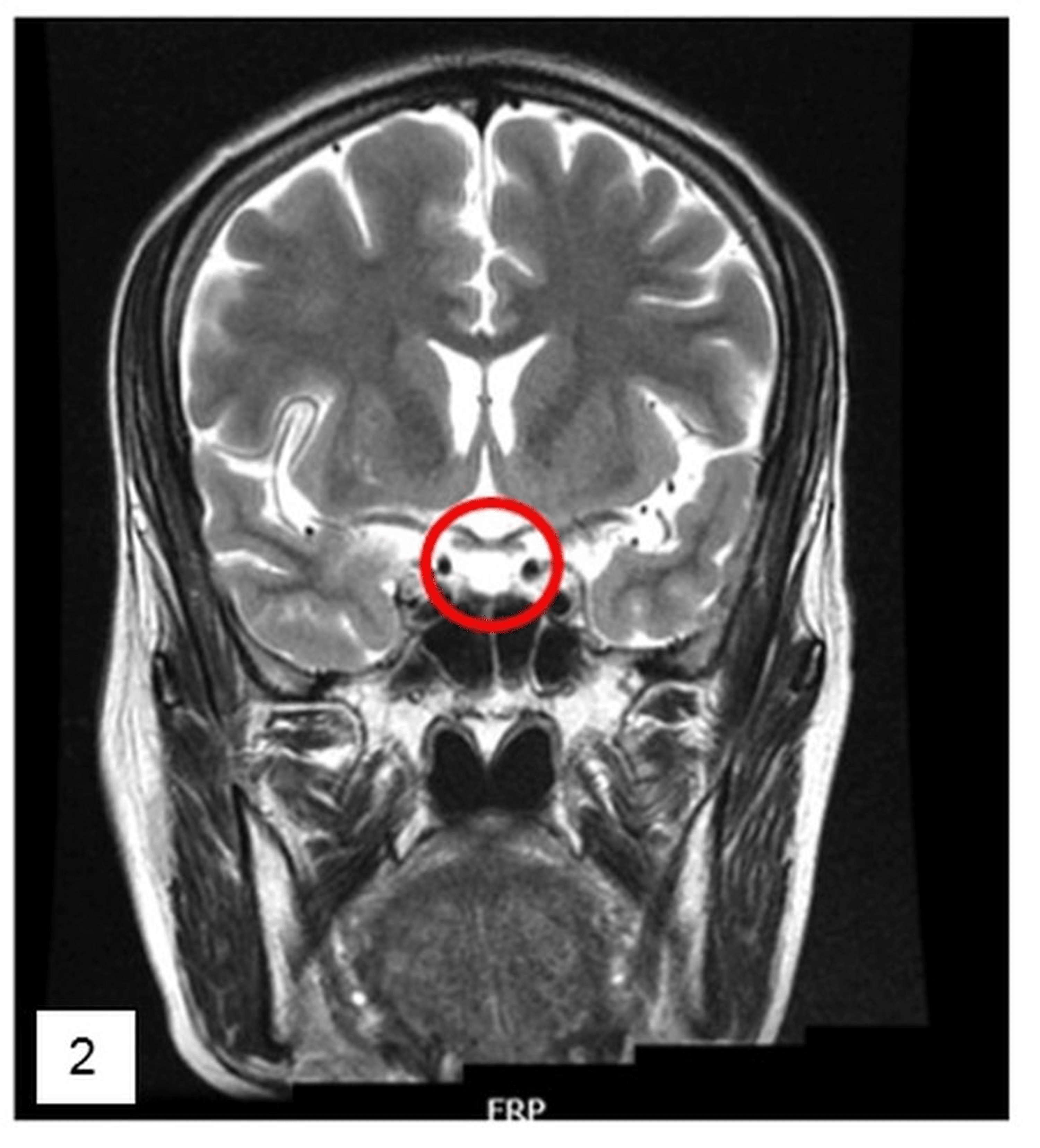 Cureus The Emptiness Within A Case Of Empty Sella Syndrome