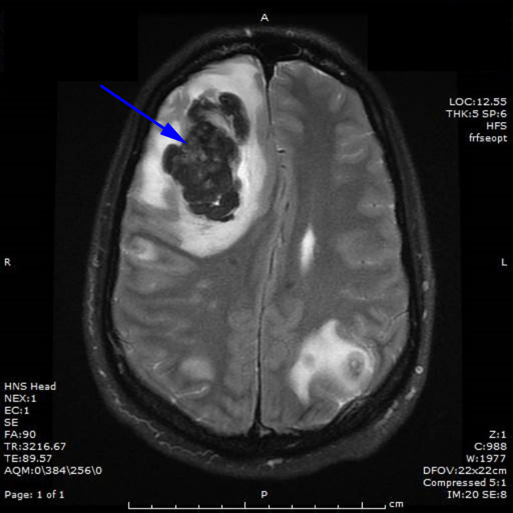 Cureus Pure Testicular Choriocarcinoma with Dermatological, Brain