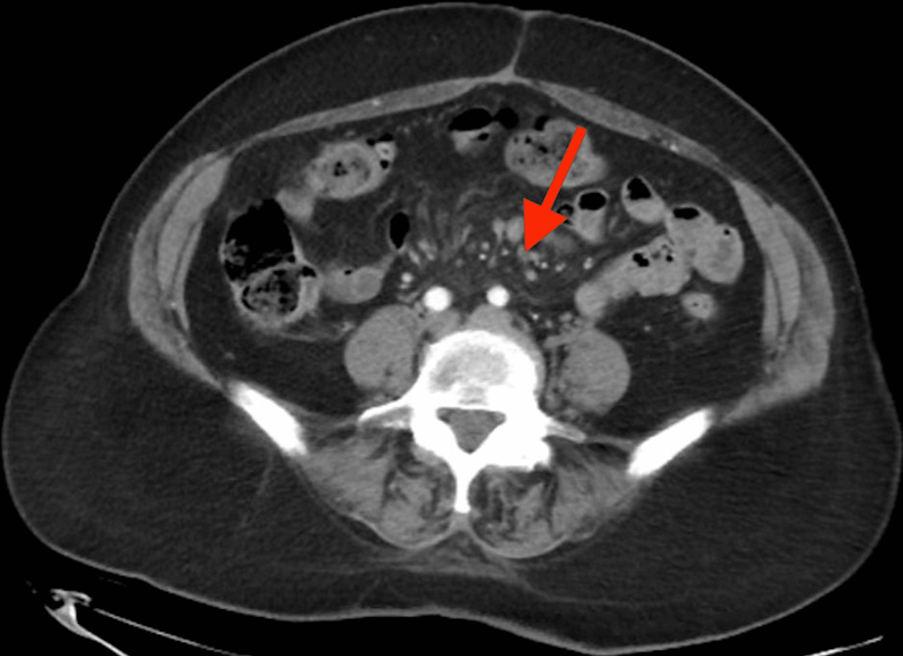 Cureus Sclerosing Mesenteritis A Rare Cause of Abdominal Pain