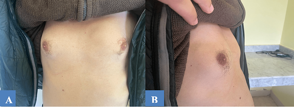 Paciente - (a) - cara - y - (b) - perfil - muestra - regresión - de - ginecomastia - 2 meses - después - discontinuación - efavirenz.