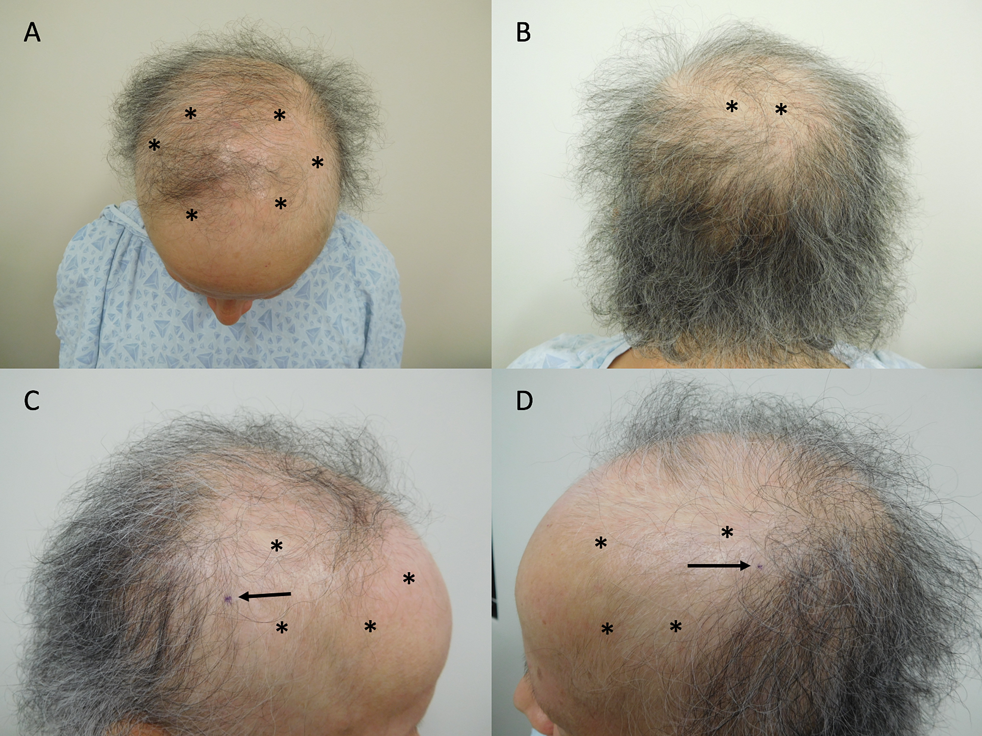 Cureus | Persistent Alopecia in a Breast Cancer Patient Following Taxane  Chemotherapy and Adjuvant Endocrine Therapy: Case Report and Review of  Post-treatment Hair Loss in Oncology Patients with Breast Cancer | Article
