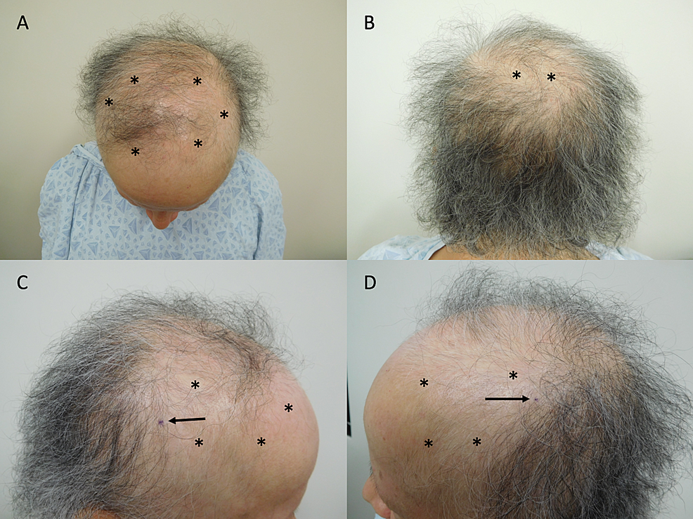 Persistent Alopecia In A Breast Cancer Patient Following Taxane 