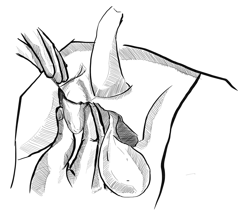 Placement-of-the-testis-in-the-right-inguinal-pouch