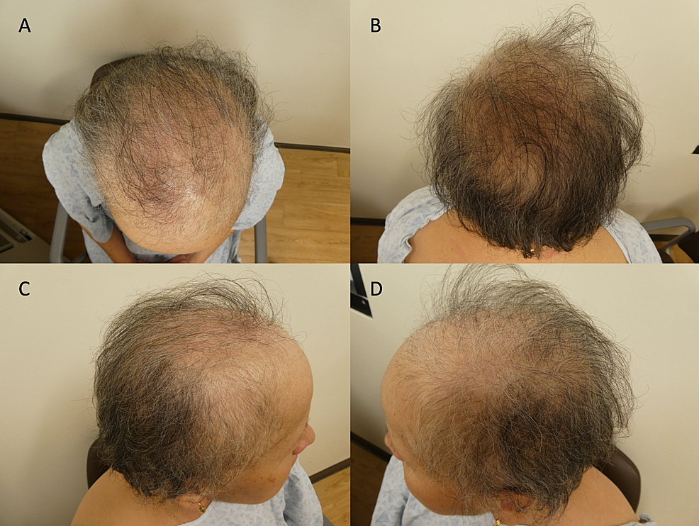 Cureus Persistent Alopecia In A Breast Cancer Patient Following 