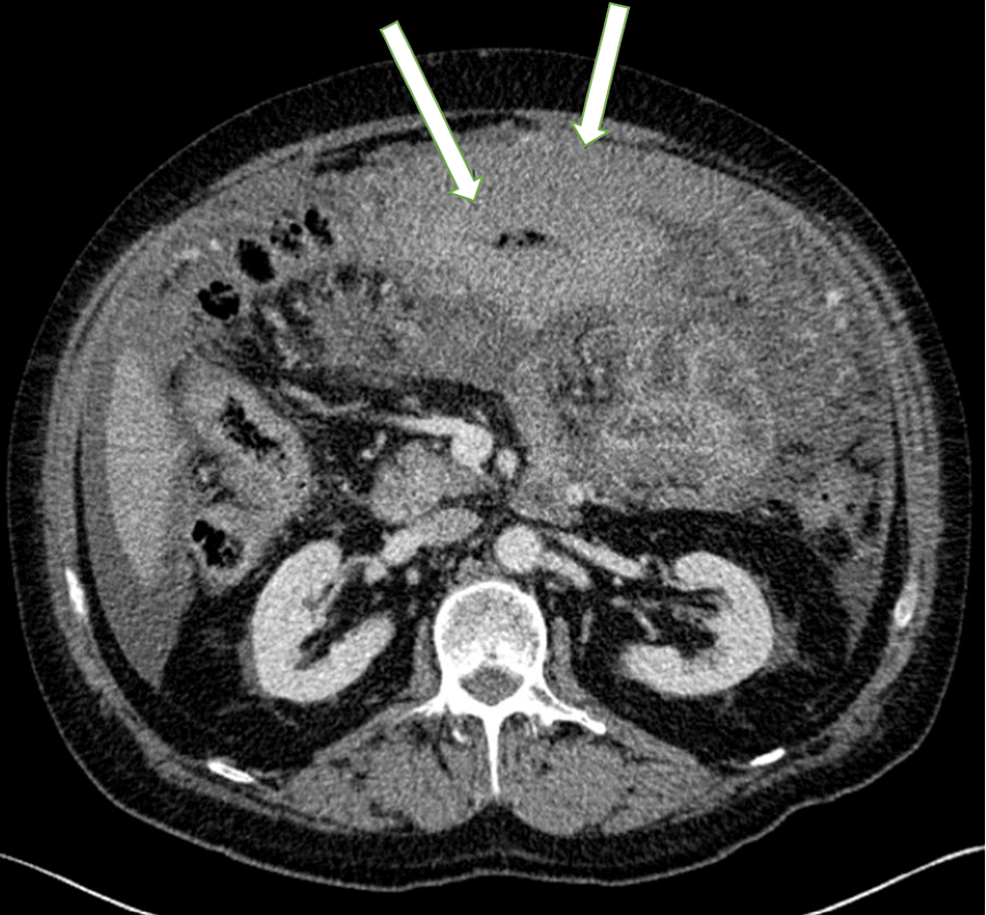Omental cake | Radiology Reference Article | Radiopaedia.org